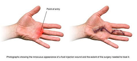Hydraulic Oil Under Skin Hydraulic Oil Under Skin